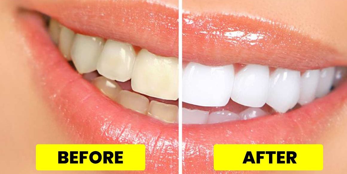 teeth whitening e1597939786332