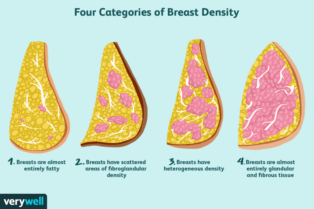 why are dense breasts a breast cancer risk 430657 v1 8493c59449b8433a906c8394895a462c