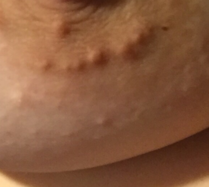 Bumps on Nipples Causes Pregnant White Spots Swollen Glands Treatment Healtreatcure