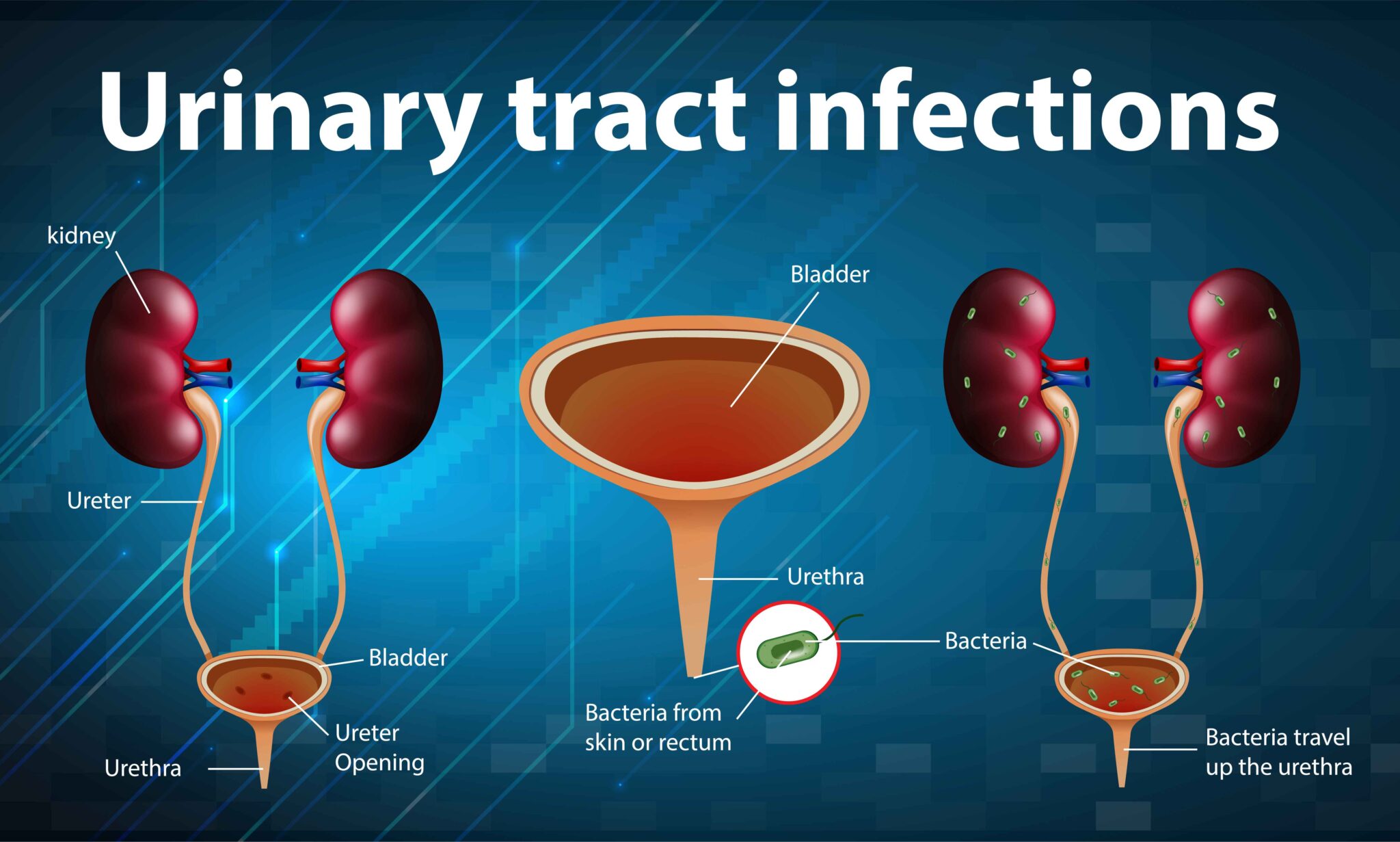 Urinary Tract Infection Treatment Market