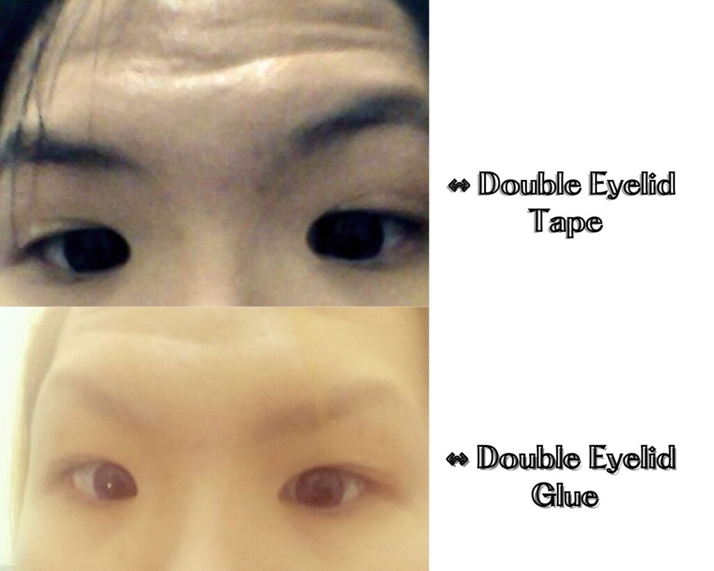 Double eyelid tape clearance vs glue