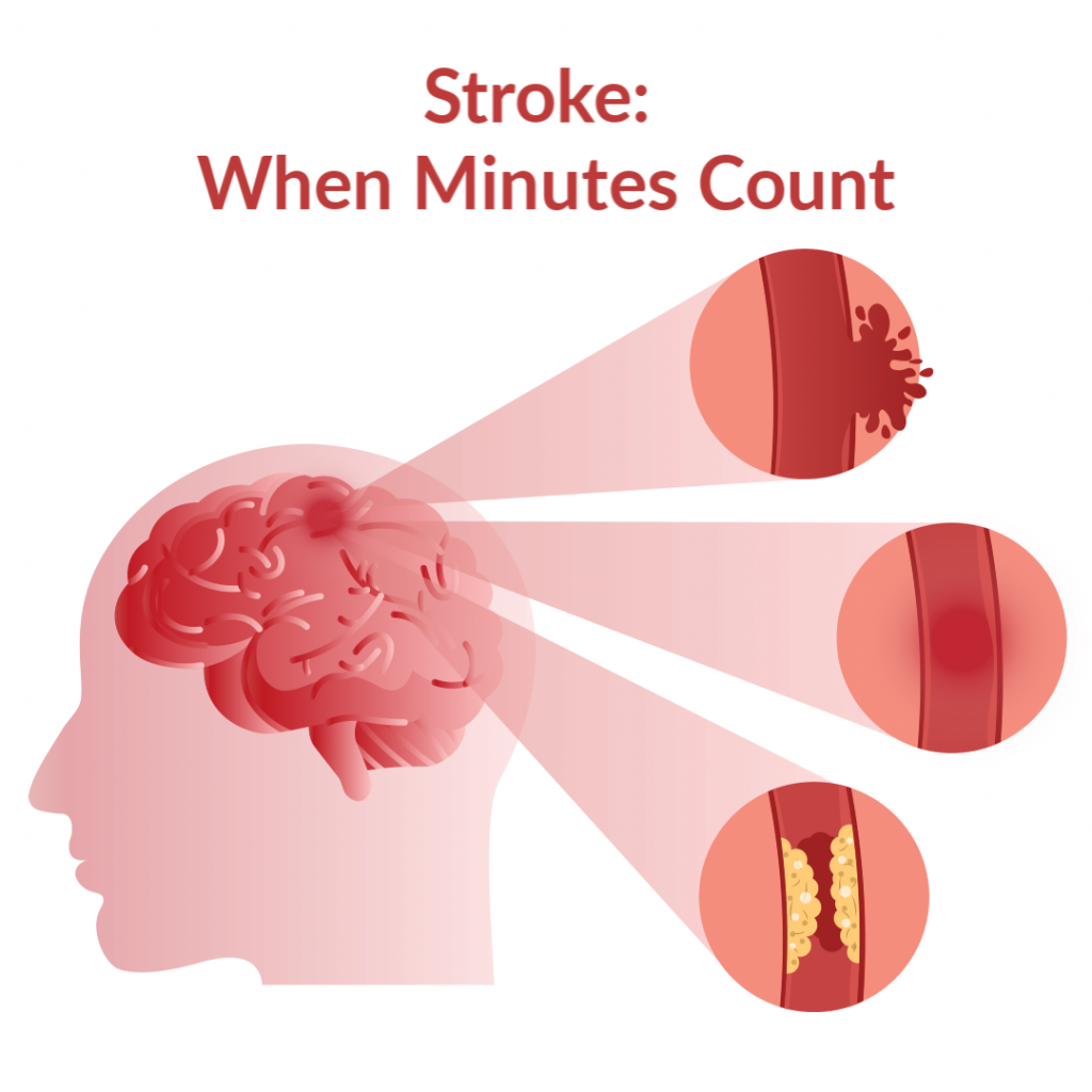 Stroke When Minutes Count 1024x1024 1