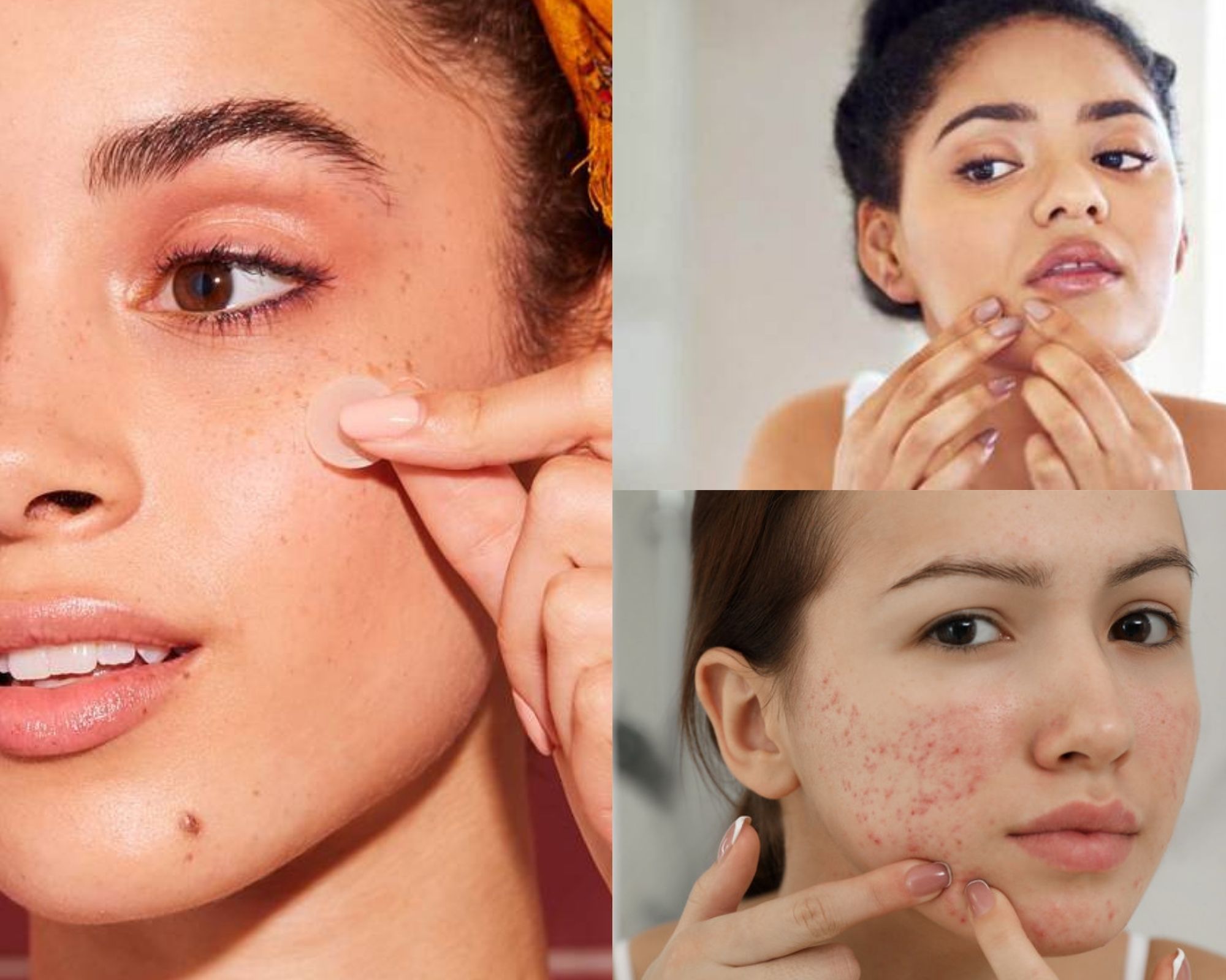 Lose The Bruise How To Minimise Bruising After Your DAMNED Pimple Pops 