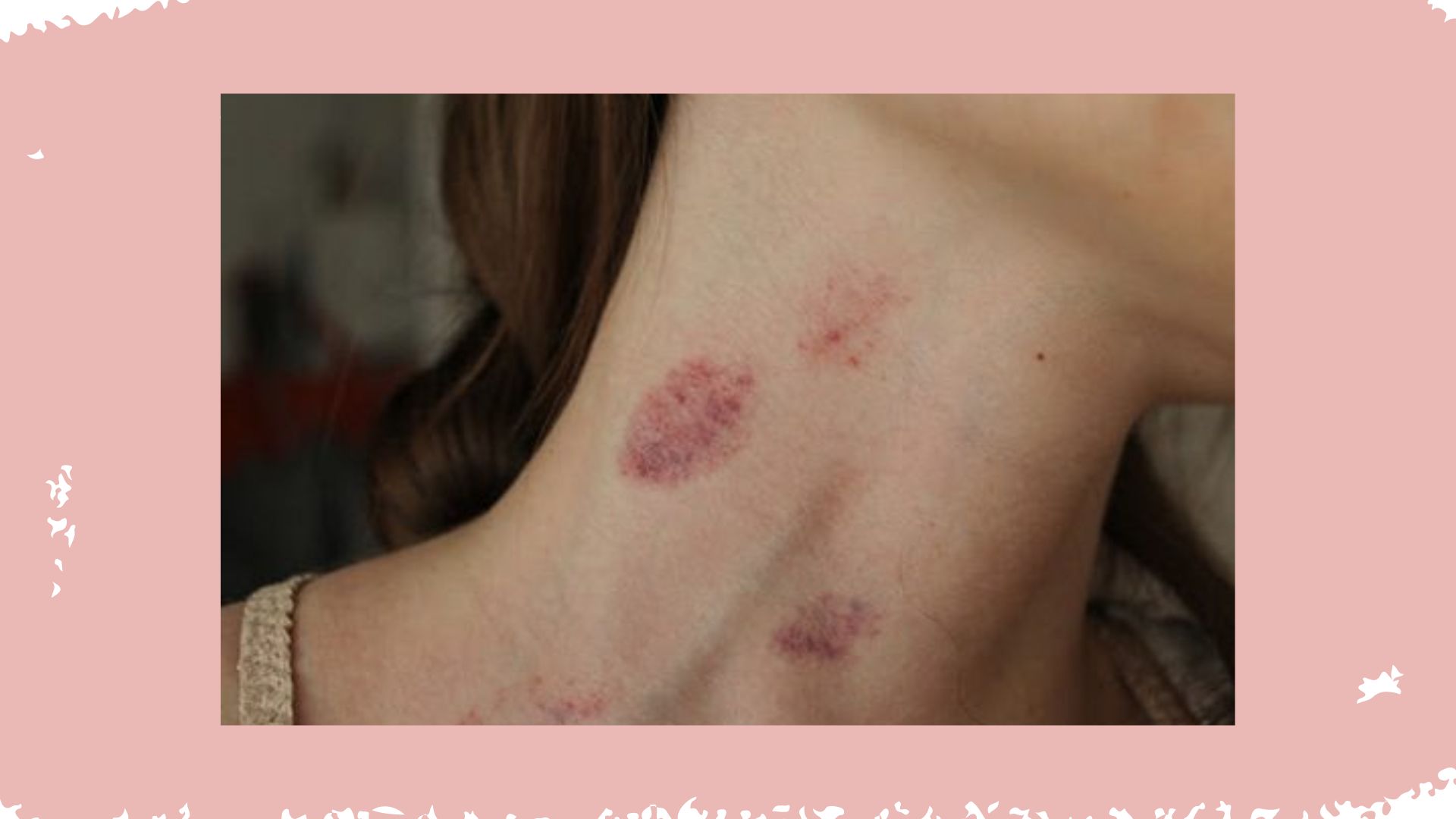 MORE Ways To Treat A Hickey (You Little Minx!) picture